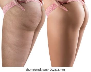 Female Buttocks Before After Cellulite Stock Photo Edit Now