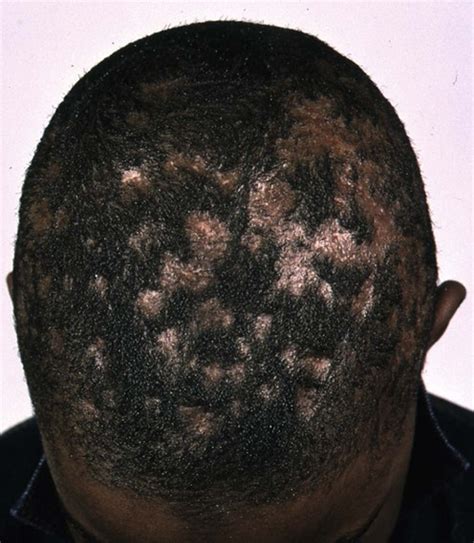 Tinea Capitis Scalp Adult Mzaerng