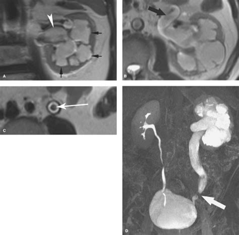 Pelvicalyceal System, Ureters, Bladder, and Urethra | Radiology Key