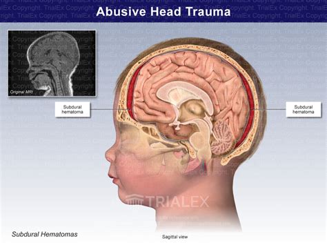 Abusive Head Trauma Subdural Hematomas Trialquest Inc