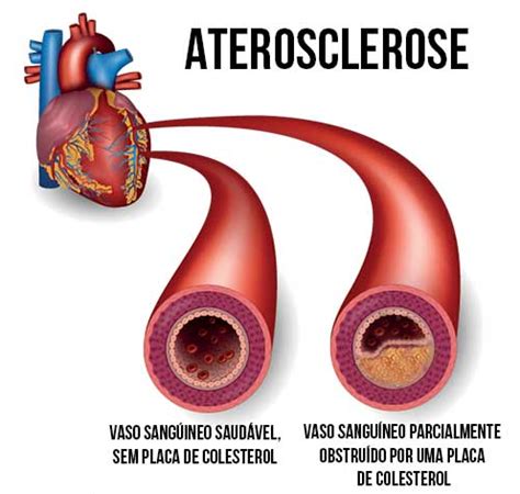 Dislipidemia saiba o que é tipos causas sintomas e tratamentos