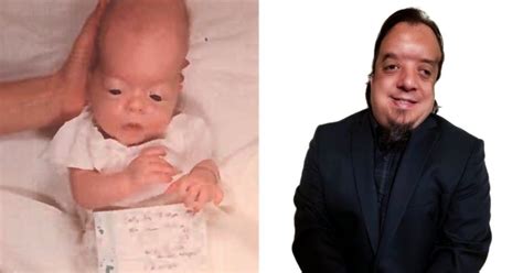 Baby Born Without Brain Gets Healed, Preaches The Word Of God | FaithPot