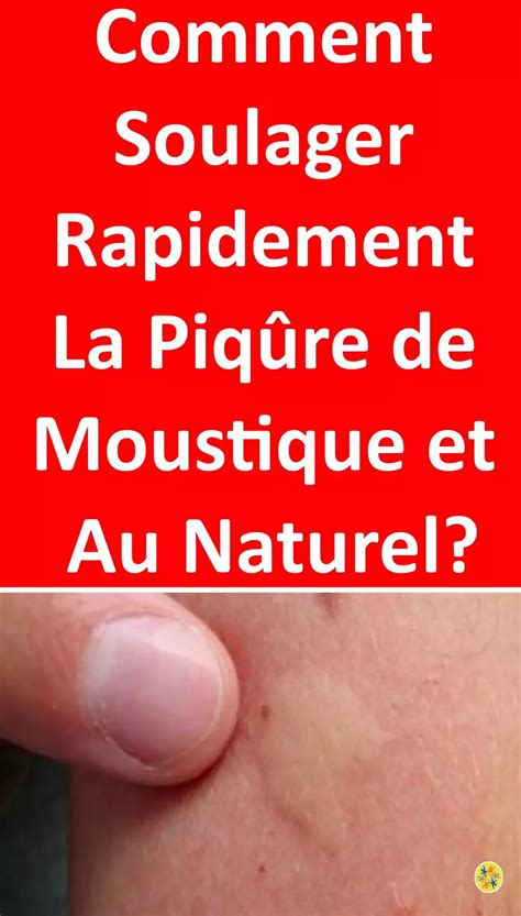 Astuces Pour Oublier Une Piq Re D Insectes Et Toute La Souffrance Qui