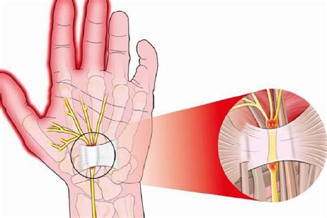 Karpal tünel sendromu nedir Karpal tünel sendromunun belirtileri