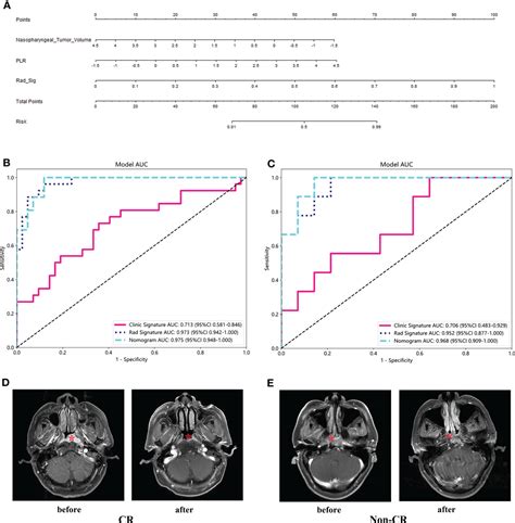 Frontiers MRI Based Clinical Radiomics Nomogram May Predict The Early