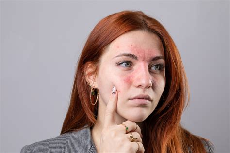 Everything You Need To Know About Rosacea Answering Your Questions