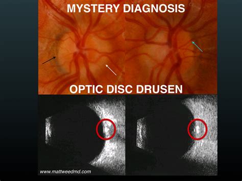 Mystery Diagnosis: Optic Disc Drusen — Matt Weed, MD Spokane Pediatric ...