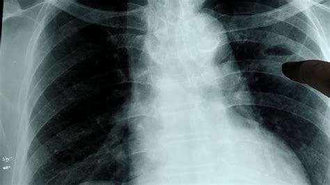 Chest X Ray Lung Abscess Air Fluid Level Youtube