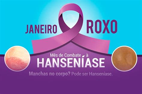 Campanha Janeiro Roxo Combate A Hanseníase