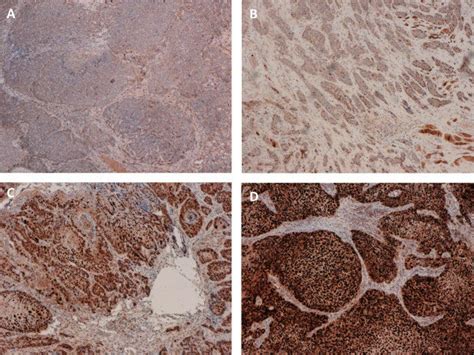 Validation of detected copy number alterations of Cyclin D1 (CCND1) by ... 