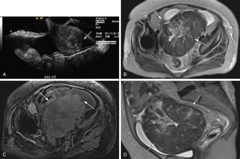 √ Uterus Endometriosis Ct Scan Diagnosing Uterine Tumors