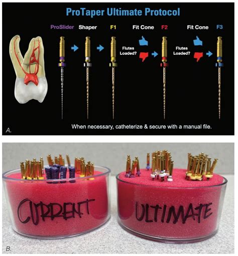 Protaper Ultimate — The Go To Endodontic Preparation Rotary System