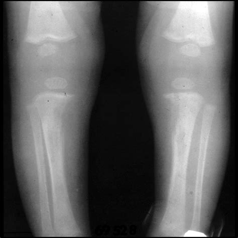 Pediatric Syphilis Pediatric Radiology Reference Article Pediatric