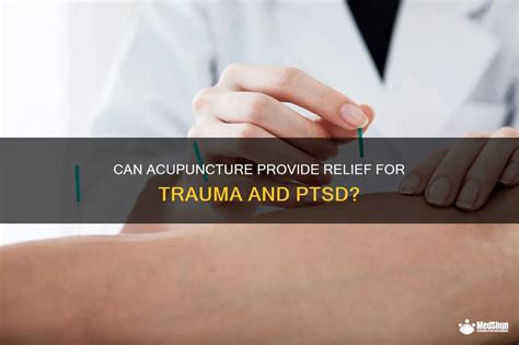 Can Acupuncture Provide Relief For Trauma And Ptsd Medshun