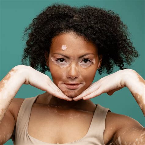 Vitiligo Spiritual Meaning A Deep Dive Into Its Symbolism