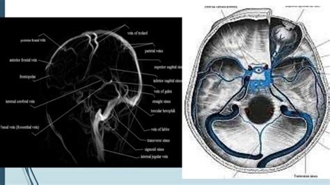 Dural venous sinus thrombosis for Radiology & Imaging