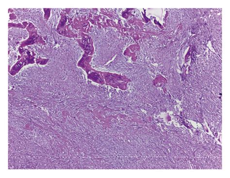 Histopathological Appearance Of Parosteal Osteosarcoma Typically Shows