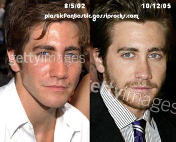 Jake Gyllenhaal Plastic Surgery Nose Lift Or Rhinoplasty