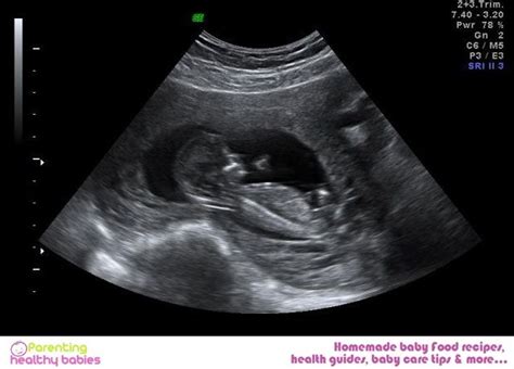 baby ultrasound pictures at 3 months - Good Piece Chronicle Photo ...