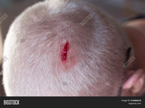 Injury Scalp. Blood Image & Photo (Free Trial) | Bigstock