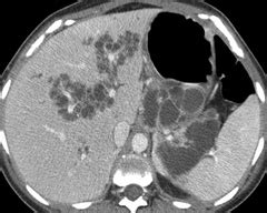 Liver Atlas Case 45 Peribiliary Cysts Typical Associated With