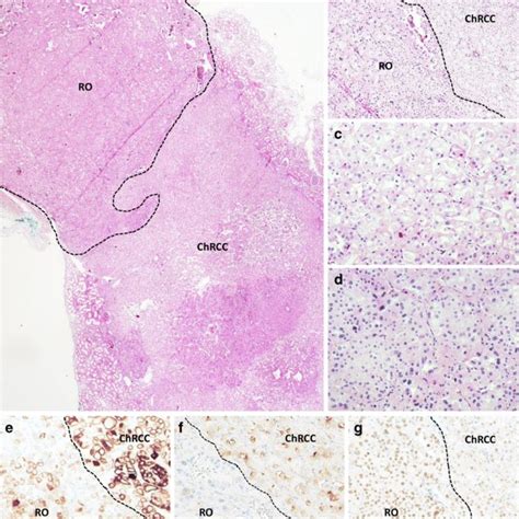 Hnf 1β As An Immunohistochemical Marker For Distinguishing Chromophobe