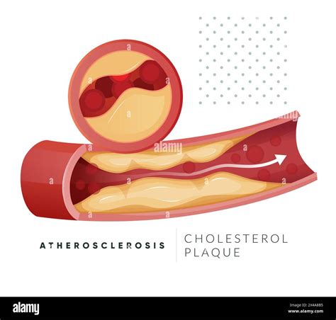 Atherosclerosis Plaque Buildup Stock Illustration As Eps File