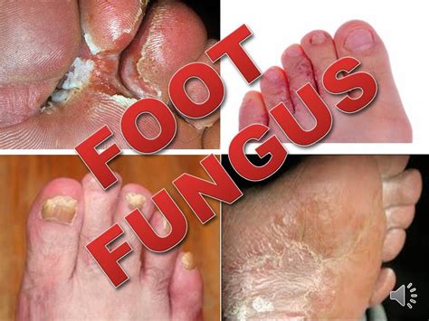 Natural Herbal Treatment For Foot Fungus Athletes Foot - YouTube