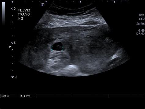 9 Week Ectopic Pregnancy Ultrasound