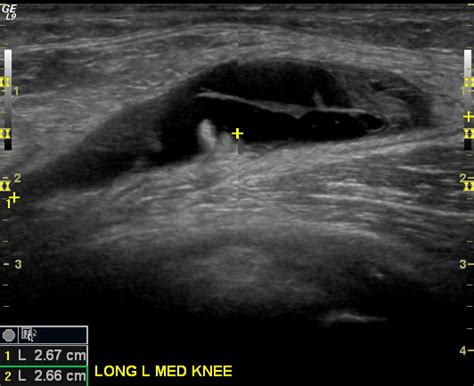 Baker Cyst Aspiration Image Radiopaedia Org