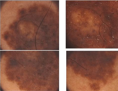 Dermoscopy showed a large melanocytic lesion characterised by an ...