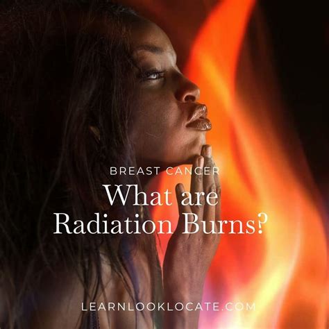 Understanding Radiation Burns Causes And Treatment Options