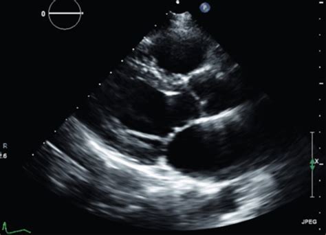 2 D ECHO EXAM Flashcards Quizlet