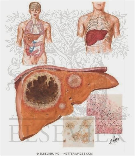 Amebiasis Intestinal Amebiasis