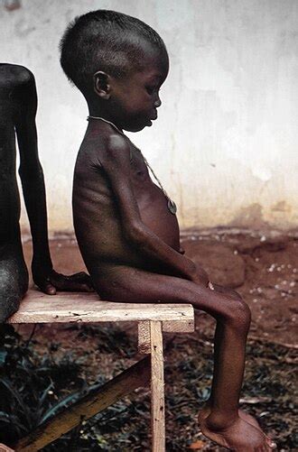 kwashiorkor viquipedia lenciclopedia lliure