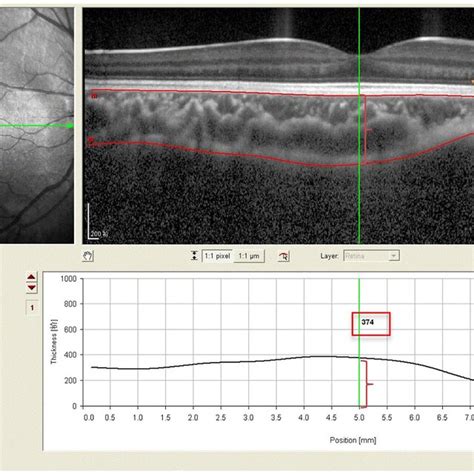 Spectral Domain Optical Coherence Tomography Sd Oct Scans Showing