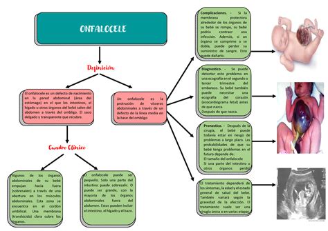 Onfalocele Onfalocele El Onfalocele Es Un Defecto De Nacimiento En La