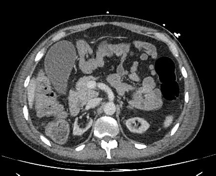 Complications Of Sickle Cell Disease Radiology Case Radiopaedia Org