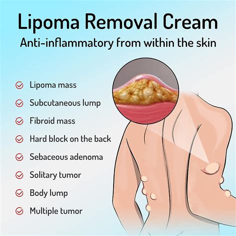 Lipoma Removal Cream 20g - Natural Treatment for Lipoma Care & Discomfort