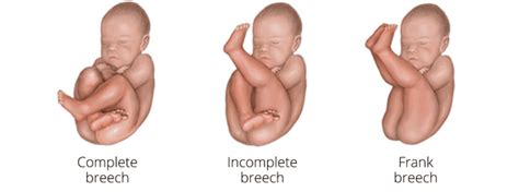 Fetus In Breech Position Illustration Photograph By Gwen 53 OFF