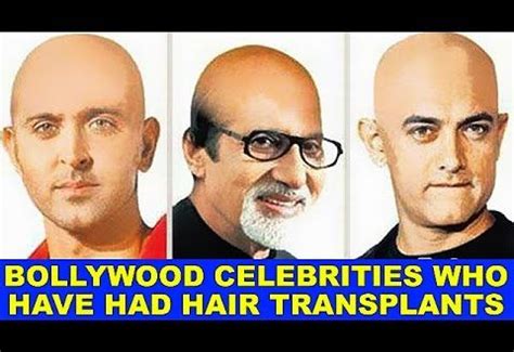 Top Bollywood Celebrities Who Have Had Hair Transplants The