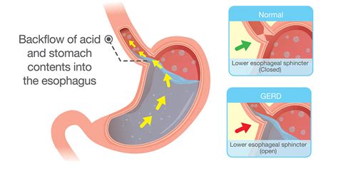 An Alternative Approach To Treating GERD And Hiatal Hernias With