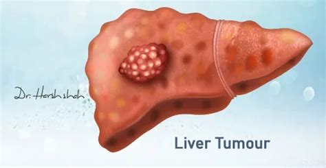 Liver Cancer: Causes, Symptoms, Diagnosis and Treatment - Dr. Harsh J Shah