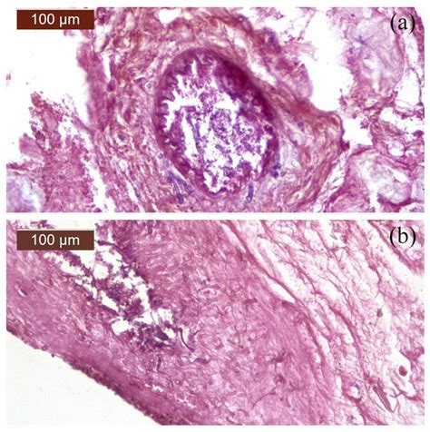 Mucor Hyphae Are Seen Infiltrating The Vascular Walls In A And B Hande