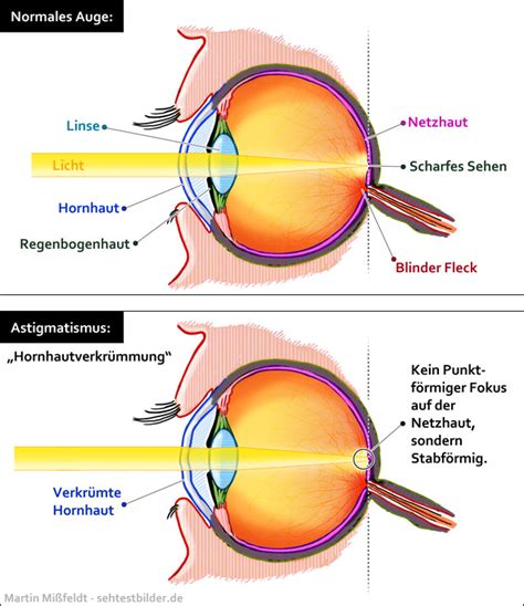 Was Ist Astigmatismus Hornhautverkr Mmung Augen