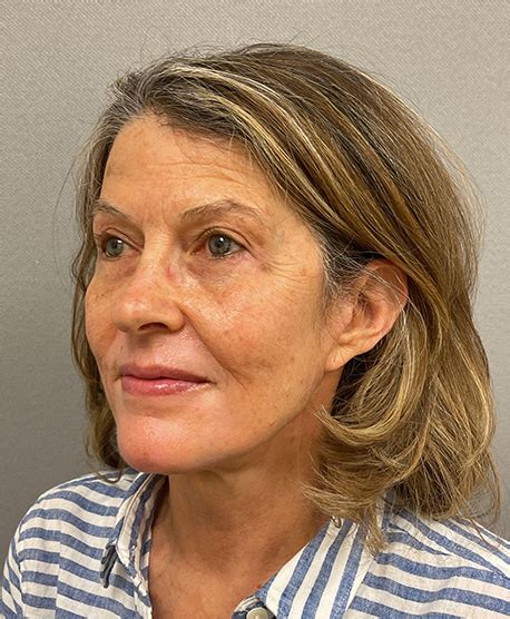 Patient 7028 Facelift Before After Photos Washington Dc Maryland