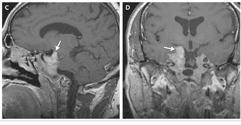 ON - RADIOLOGY: Large Prolactinoma on MRI imaging