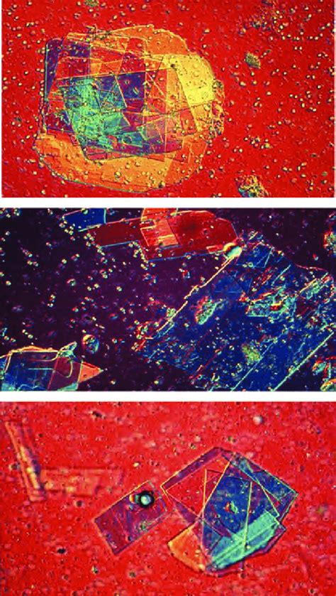 Cholesterol crystals (1)—Electronic microscopy—moving in blood stream ...