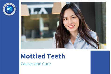 What is mottled teeth - The Dental Solutions