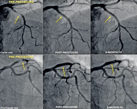 First In Human Evaluation Of A Novel Poly L Lactide Based Sirolimus